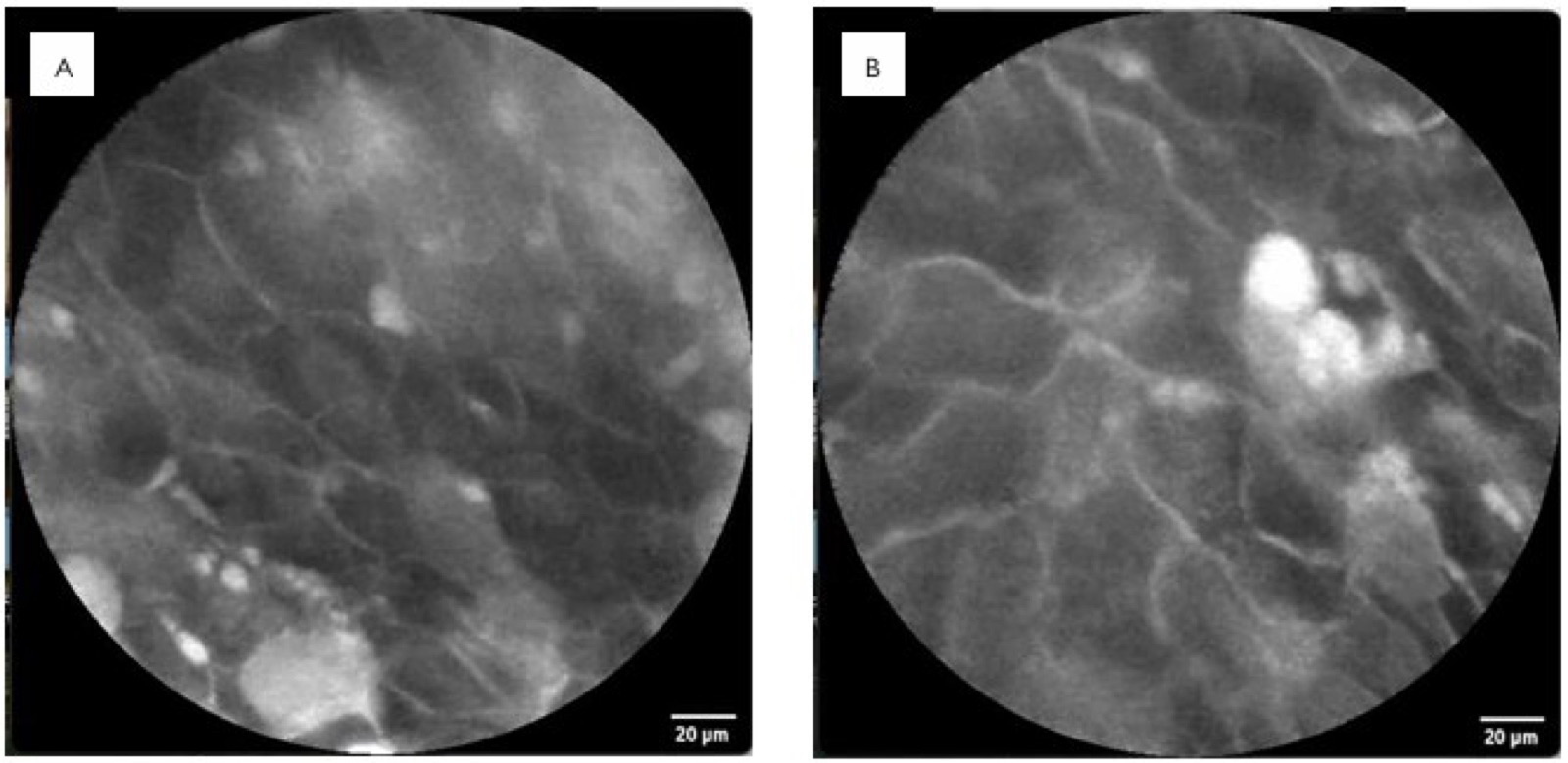 Probe-based confocal laser endomicroscopy for prediction of uterine rejection in a patient submitted to live-donor uterus transplantation 1 Visual abstract