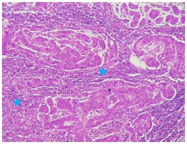 Prognostic value of tumor-infiltrating lymphocytes and their association with clinical and pathological factors in gastric cancer. 1 Visual abstract