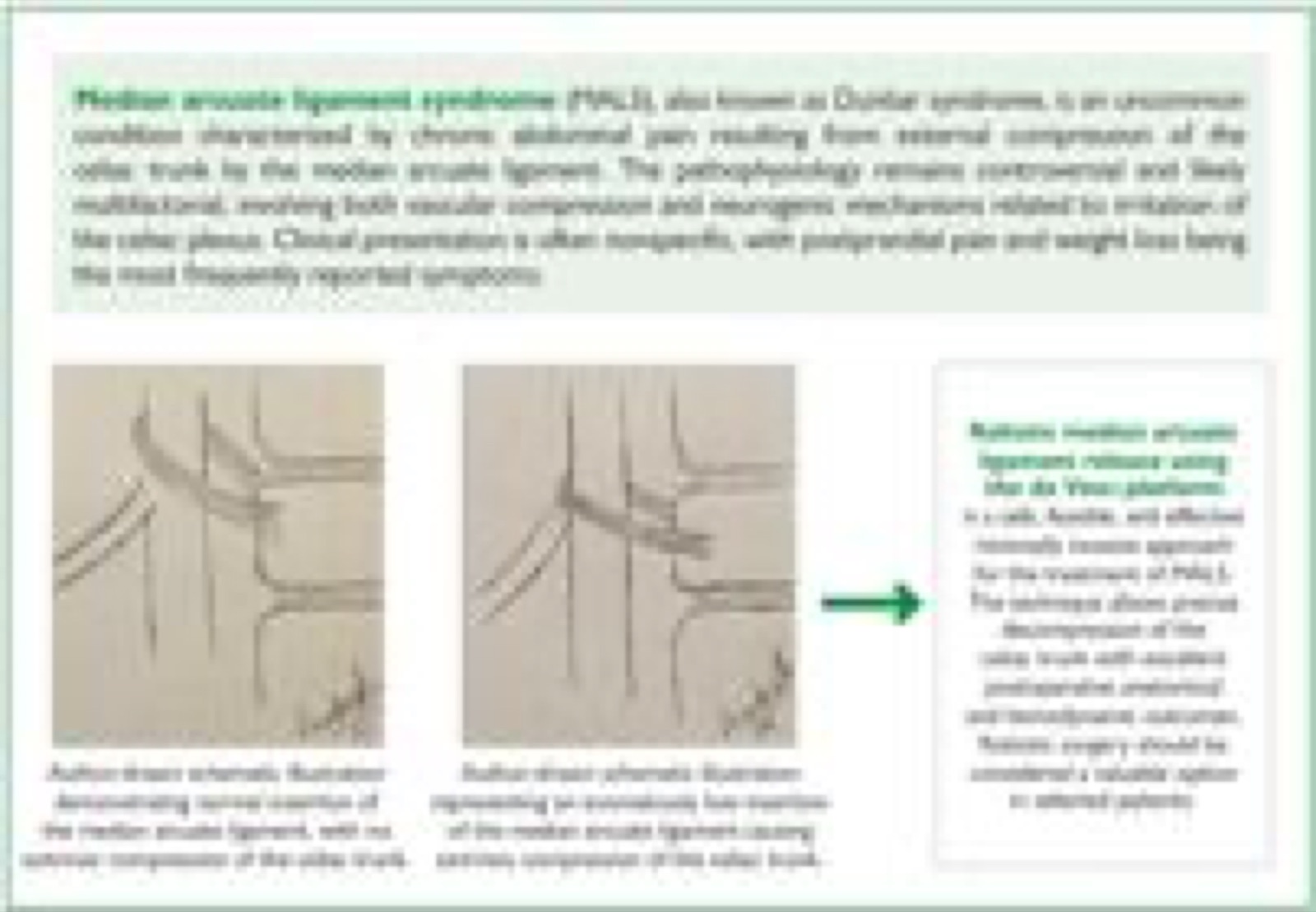 Robotic surgery for median arcuate ligament syndrome: technical aspects and imaging correlation 2 Visual abstract